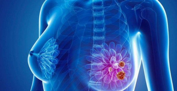 Ung thư vú là bệnh phổ biển ở phụ nữ ngoài 40